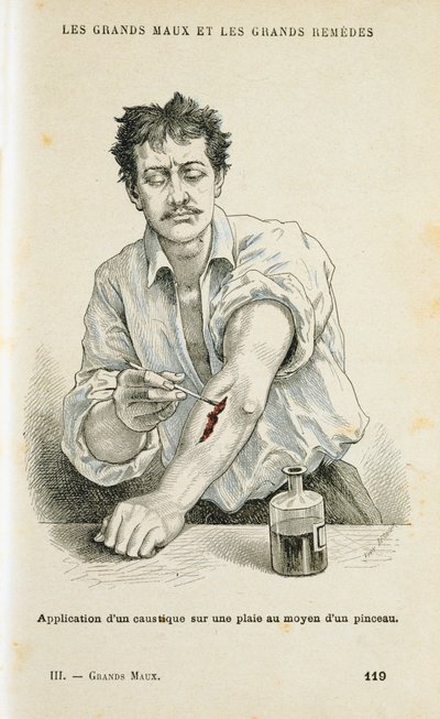 Een wond schilderen met een antiseptische oplossing, ca. 1890 door Unbekannt