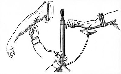 Persoon-tot-persoon bloedtransfusie, 1833 door Unbekannt
