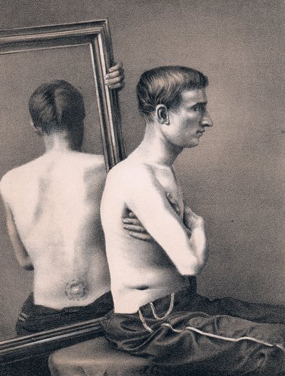 Herstel van een kogelwond in de buik, Amerikaanse Burgeroorlog, 1865 door Unbekannt