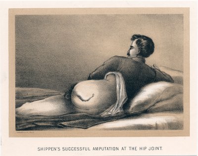 Shippens succesvolle amputatie aan het heupgewricht, Amerikaanse Burgeroorlog, 1865 door Unbekannt