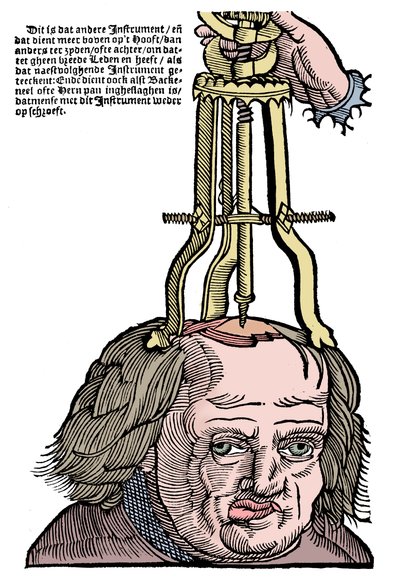 Trepanatie, 1593 door Unbekannt