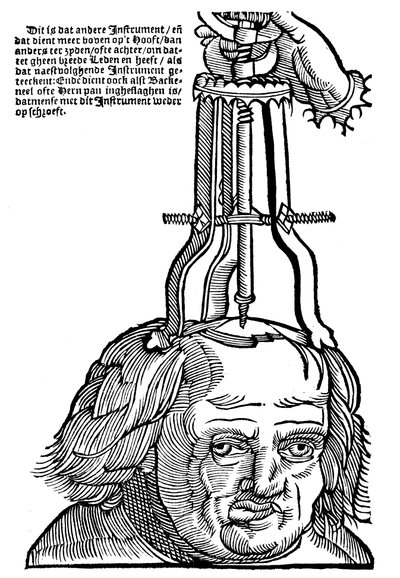 Trepanatie, 1593 door Unbekannt