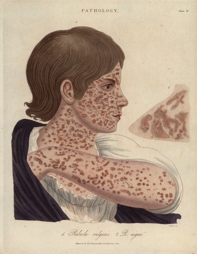Mazelen en Rubeole - Lithografie door John Pass, gepubliceerd in 