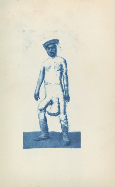 Elephantiasis door Unknown 19th Century