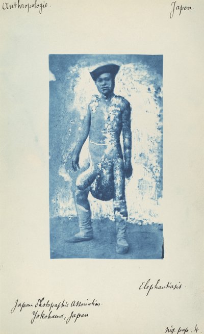 Elephantiasis door Unknown 19th Century