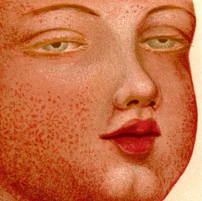 Eruptieve Koortsen: Scarlatina of Roodvonk door Unknown artist