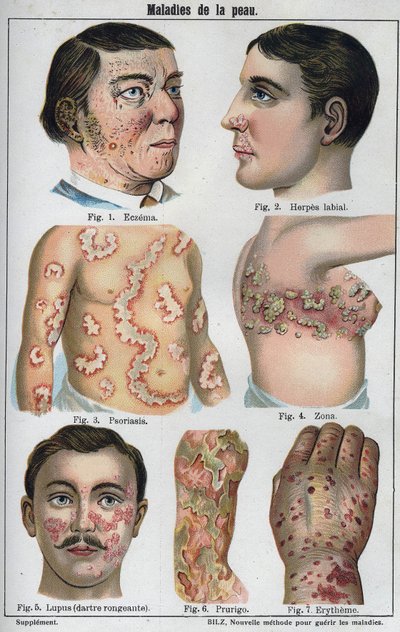 Huidziekten: Eczeem, labiale herpes, psoriasis, gordelroos, lupus (rottende darter), prurigo, erytheem. 