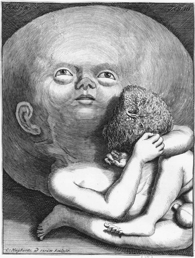 Monster: Kind hydrocephalus antropologie - gravure, eind 18e eeuw door Unknown artist
