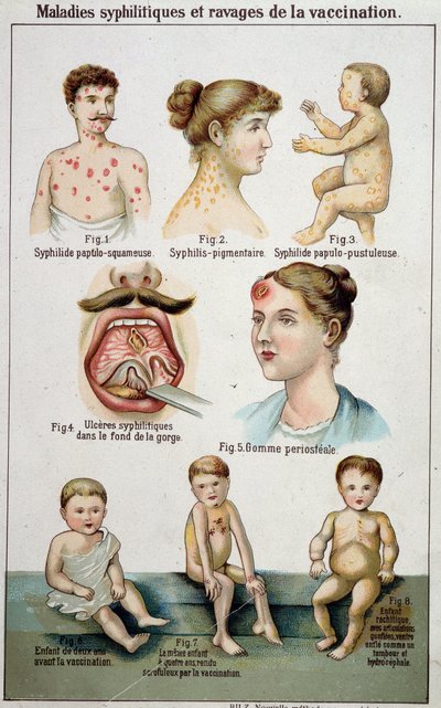 Plaat die de verschillende vormen van syfilitische ziekten en de gevaren van vaccinatie illustreert - in Bilz natuurlijke geneeskunde, eind 19e eeuw door Unknown artist
