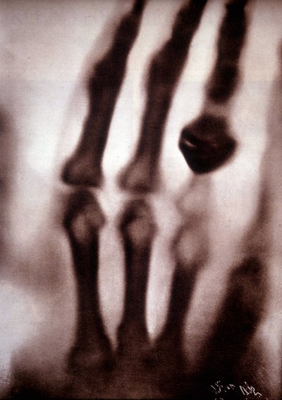 Röntgenstralen of X-stralen Eerste foto: de hand van de vrouw van Röntgen. 22/12/1895. door Unknown artist