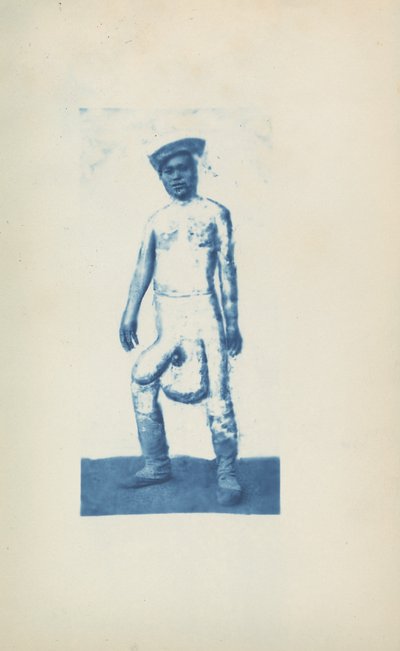 Elefantiasis,ca. 1870 (foto) door Unknown photographer