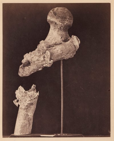 Luitenant Goodwin, overleden, eenzijdige schotbreuk van het bovenste derde deel van de rechter dijbeen, zeven maanden na de verwonding, uit de fotocatalogus van de chirurgische afdeling door William Bell