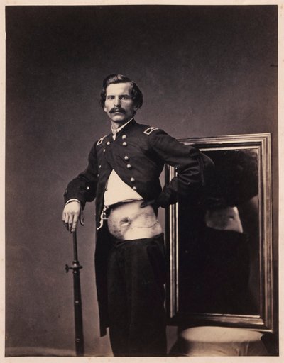 Majoor H.A. Barnum, Herstel na een doordringende schotwond in de buik met perforatie van de linker keelholte, uit de fotocatalogus van de afdeling Chirurgie door William Bell