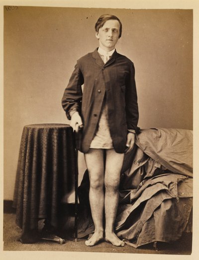 Soldaat G. W. Warrington, Herstel zonder amputatie na een schotbreuk in de rechterpatella, uit de fotocatalogus van de chirurgische afdeling door William Bell