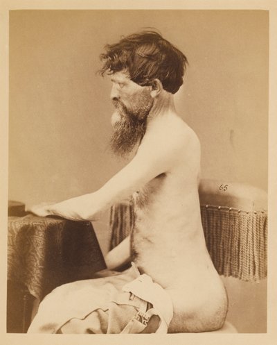 Soldaat John Bar, Herstel na een penetrerende buikwond met breuk van de linker Os Innominatum, uit de fotocatalogus van de chirurgische afdeling door William Bell