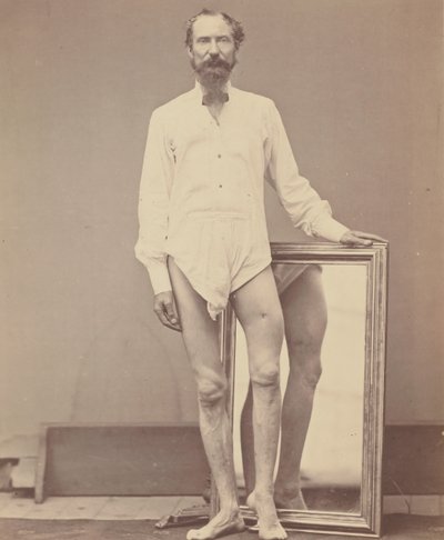 Schotwond van het Middelste Derde van het Linker Dijbeen, 1865-67 door William H. Bell