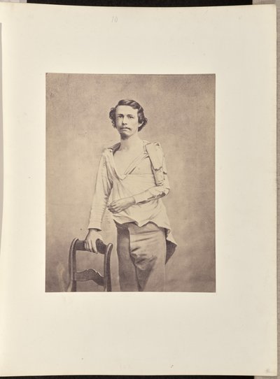 Succesvolle excisie van de kop van de linker humerus, gevolgd door necrose en secundaire excisie van de rest van de humerus en de bovenste extremiteiten van de radius en ulna door William H. Bell