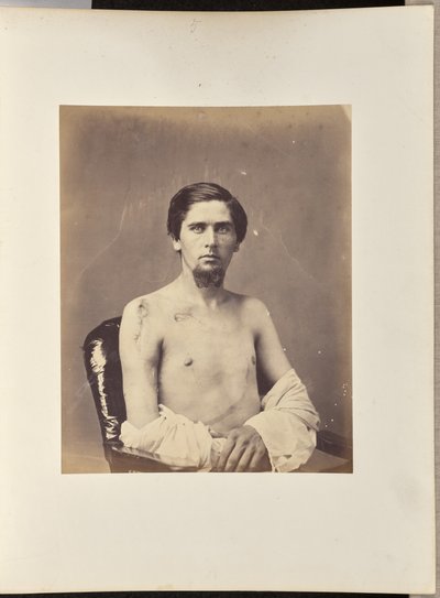 Succesvolle excisie van de kop van de rechter humerus door William H. Bell