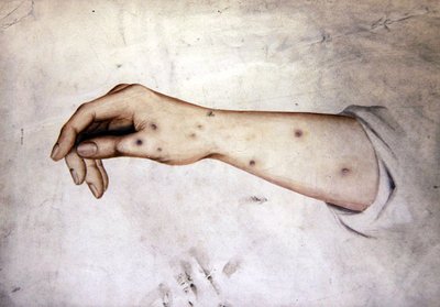 Studie van een Onderarm met Huidconditie, ca. 1850 door William Lover