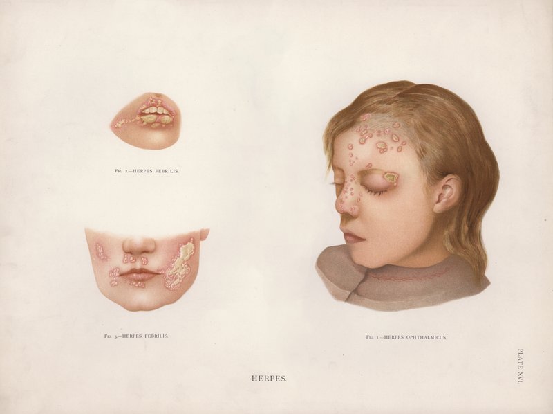 Huidaandoeningen: Herpes door English School