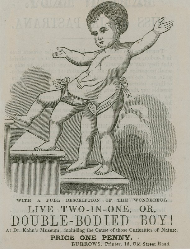 Levende twee-in-één, of dubbel-lichamige jongen door English School