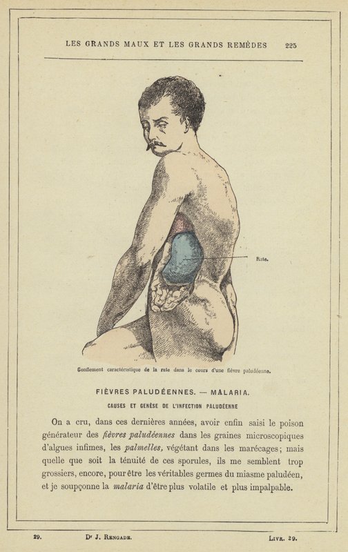 Kenmerkende zwelling van de milt tijdens een malaria-koorts door French School
