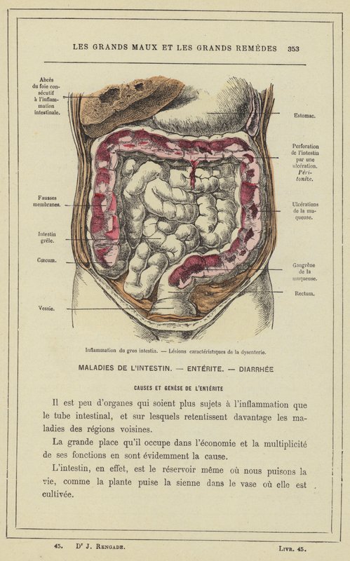 Ontsteking van de dikke darm, kenmerkende laesies van dysenterie door French School