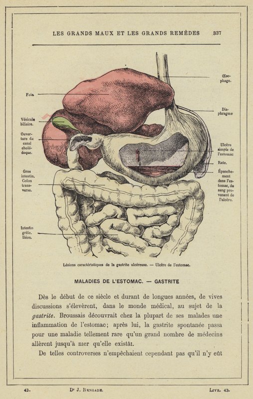 Kenmerkende laesies van ulceratieve gastritis, maagzweer door French School