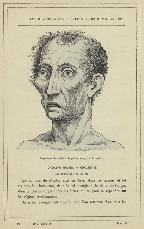 Gezicht van de patiënt in de verstikkingsfase van cholera door French School