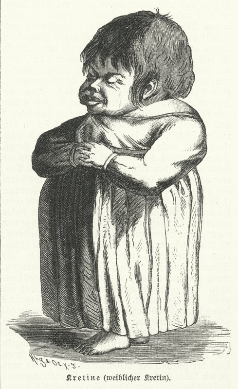 Kretin, vrouw die lijdt aan aangeboren jodiumtekortsyndroom (gravure) door German School