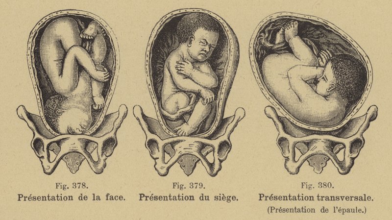 Verkeerde ligging van baby