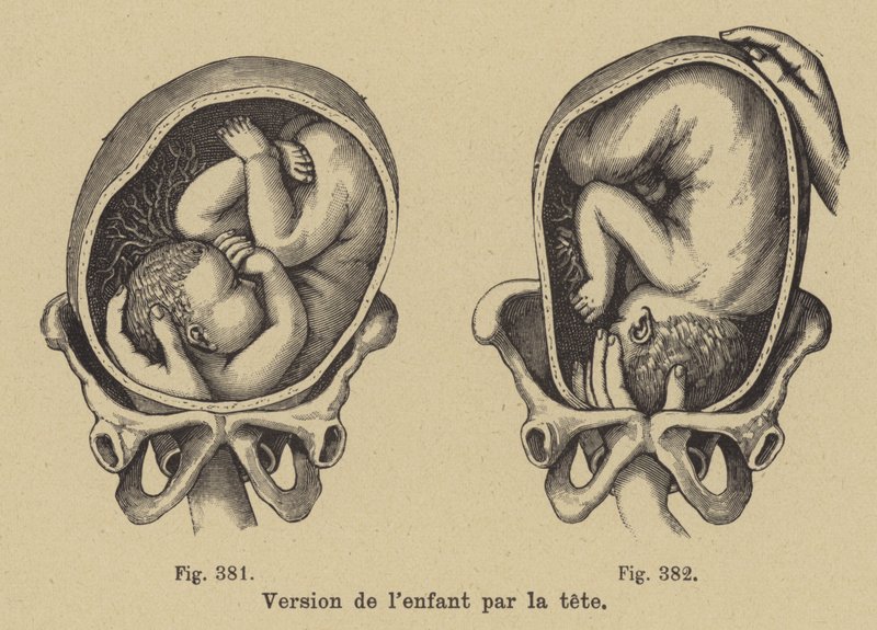 Draaien van een baby in de baarmoeder zodat het hoofd naar beneden wijst voor de geboorte door German School