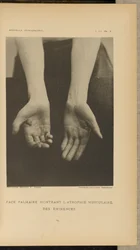 Palmar oppervlak met spieratrofie van de eminences