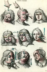 Chirurgie in de 18e eeuw: trepanatie en operatie van het oog en het gezicht. Gravure in ‘Institutionis chirurgicae’ van Lorenzo Heister