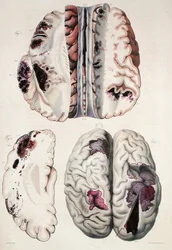 Capillaire apoplexie, uit 
