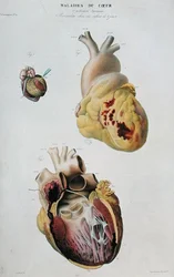 Plaat met hartziekten. Spontane scheuring van het hart van een 86-jarige vrouw (fig. 1) en pericarditis bij een zes dagen oude baby (fig. 2), uit 