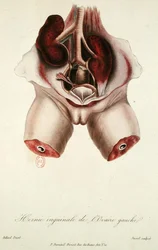 Inguinale hernia van de linker eierstok, uit 