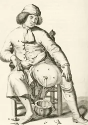 Aftappen van vocht uit een abces, uit Exercitationes Practicae circa Medendi Methodum door Frederik Dekkers, 1694