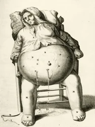 Aftappen van vocht uit een abces, uit Exercitationes Practicae circa Medendi Methodum door Frederik Dekkers, 1694