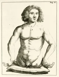 Voorbeeld van aangeboren geboorteafwijkingen, uit Exercitationes Practicae circa Medendi Methodum door Frederik Dekkers, 1694
