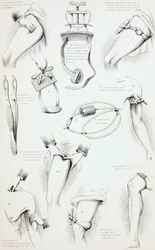 Methoden om Bloeden te Stoppen, ca. 1890