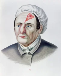 Na een huidtransplantatie-operatie, uit Selecta Praxis Medico-Chirurgica door Alexander Auvert, Parijs, 1856