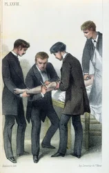 Amputatie van een arm, uit een medisch handboek door Jean-Baptiste-Leon Dubreuil, ca. 1850-60