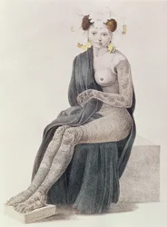 Aangeboren ichthyosis, uit een boek door G.M. Olbers, 1830