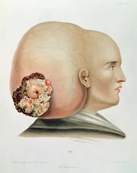 Schimmel van de dura mater, uit Selecta Praxis Medico-Chirurgica door Alexander Auvert, Parijs, 1856