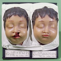 Model dat een kinderlijk gezicht toont voor en na een operatie om een hazenlip te corrigeren uitgevoerd door Antoine Dubois (1756-1837) in 1799 (was)