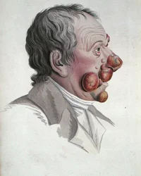 Mycosis Fongoide, uit een boek door Baron Jean Louis Alibert 1838 (gekleurde gravure)