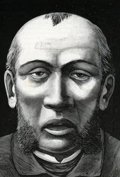 Patiënt met hersenverweking (gravure) 1888