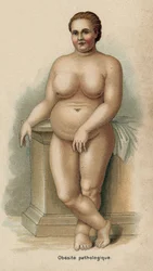 Portret van een vrouw met pathologische obesitas (print)