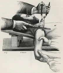 Resectie van de schouder (uit 